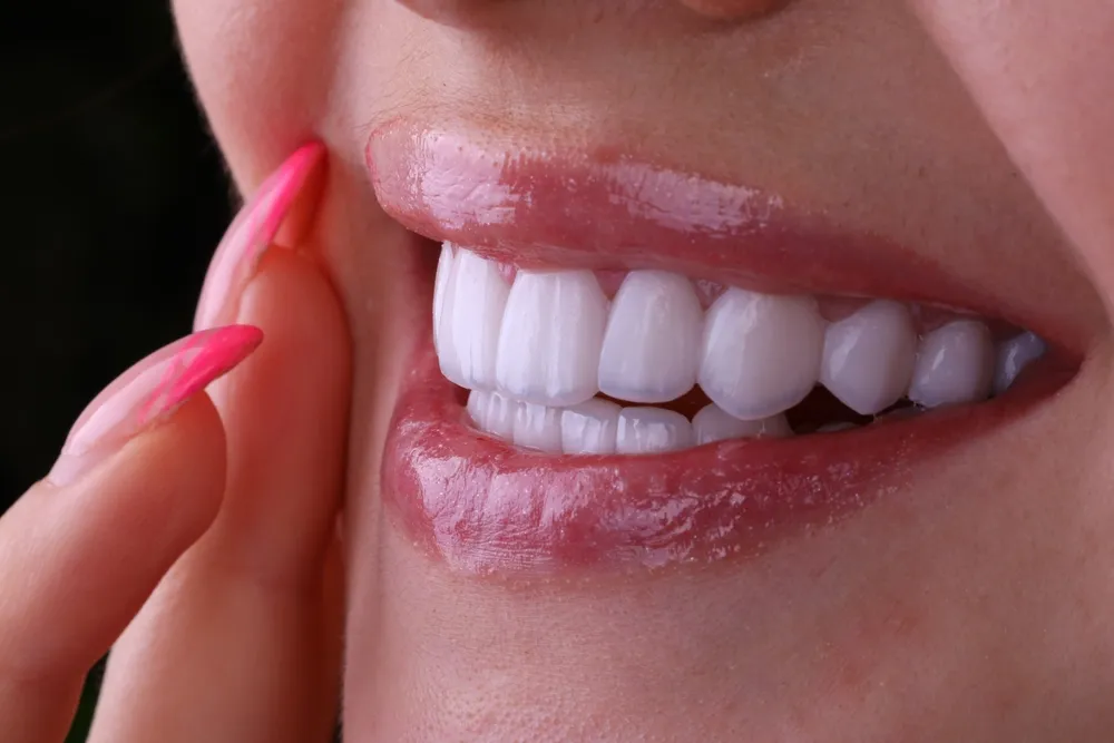 Hollywood Smile Cost in Dubai
