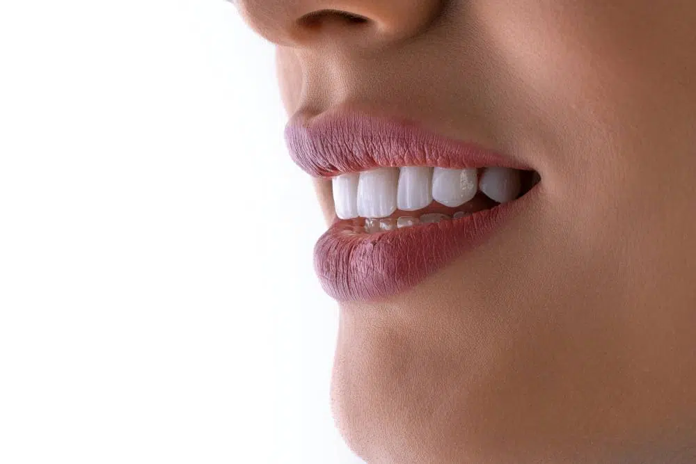 Hollywood Smile Cost in Dubai