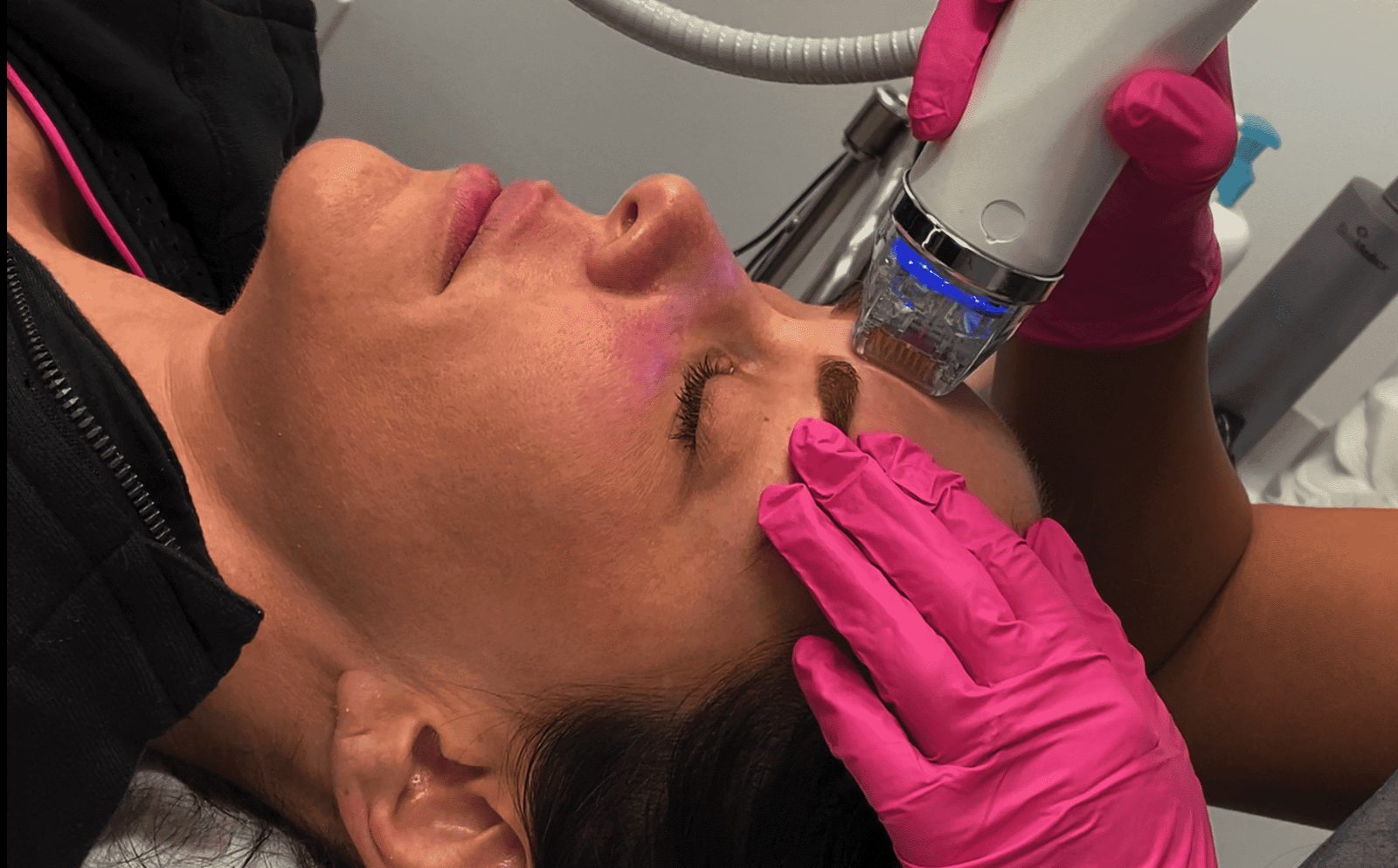 لماذا تختارين Tinkermoon Clinic لـ Microneedling RF في دبي؟