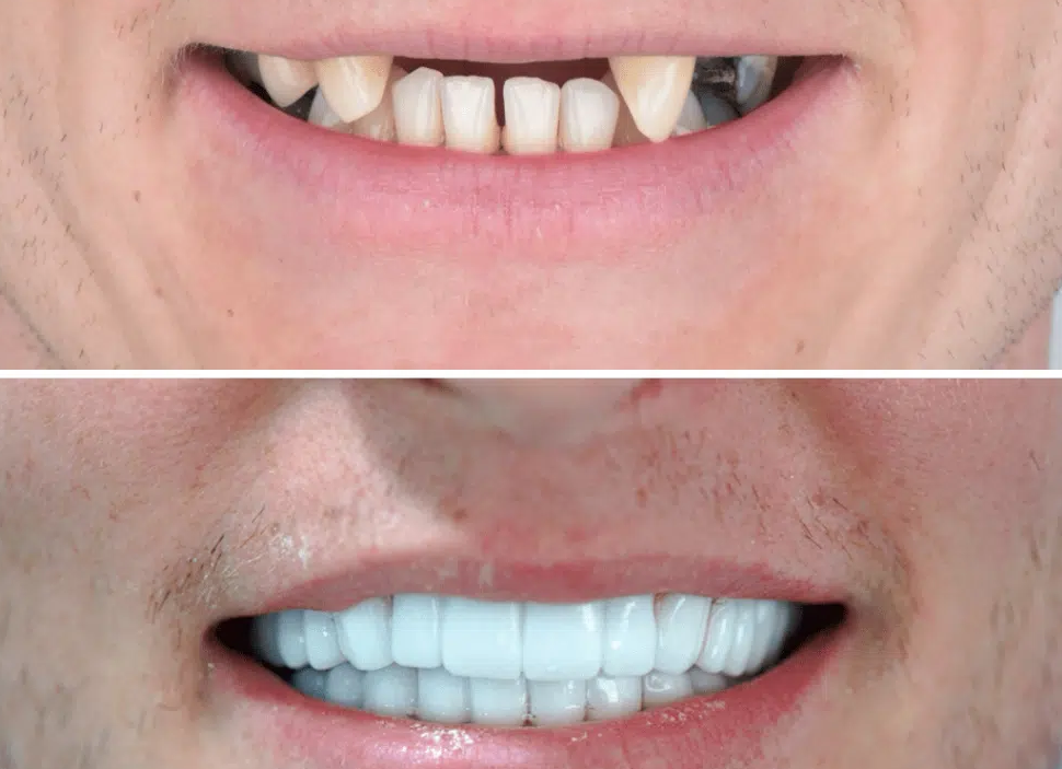 Dental Implants Before and After