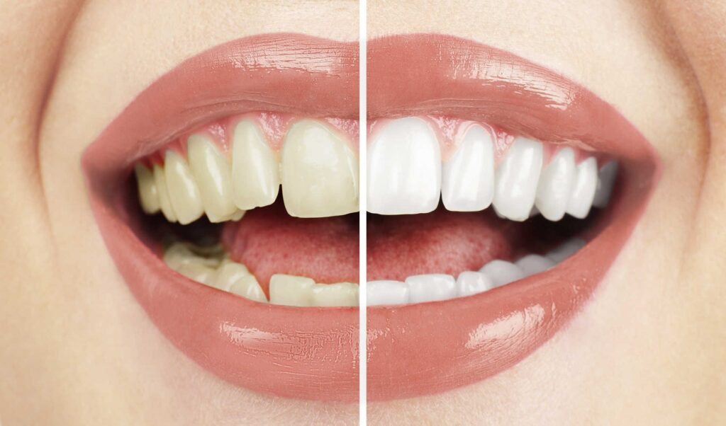 Hollywood Smile Before and After