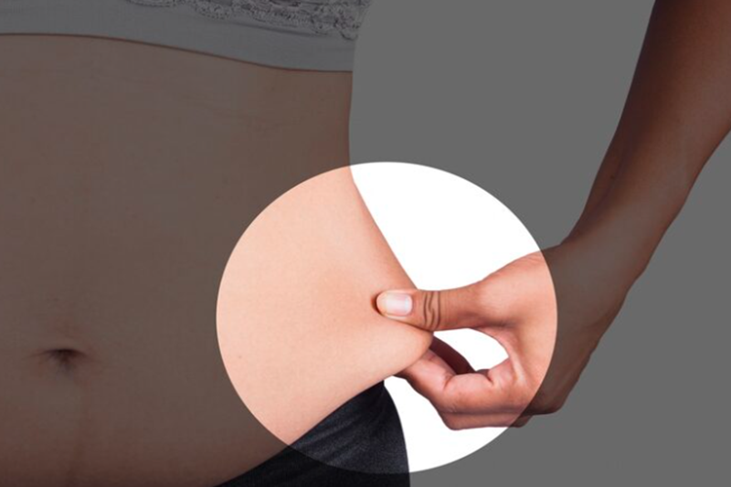 Is Liposuction Permanent?