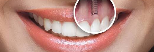 After Implants