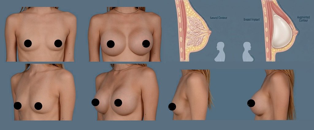 Can Breast Implants Create Breasts?
