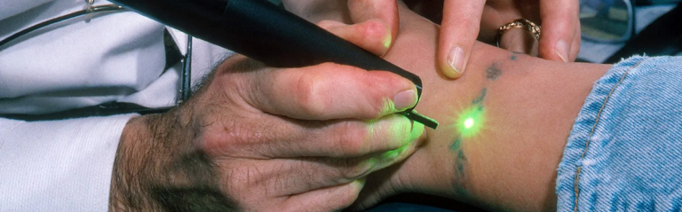 Tattoo Removal