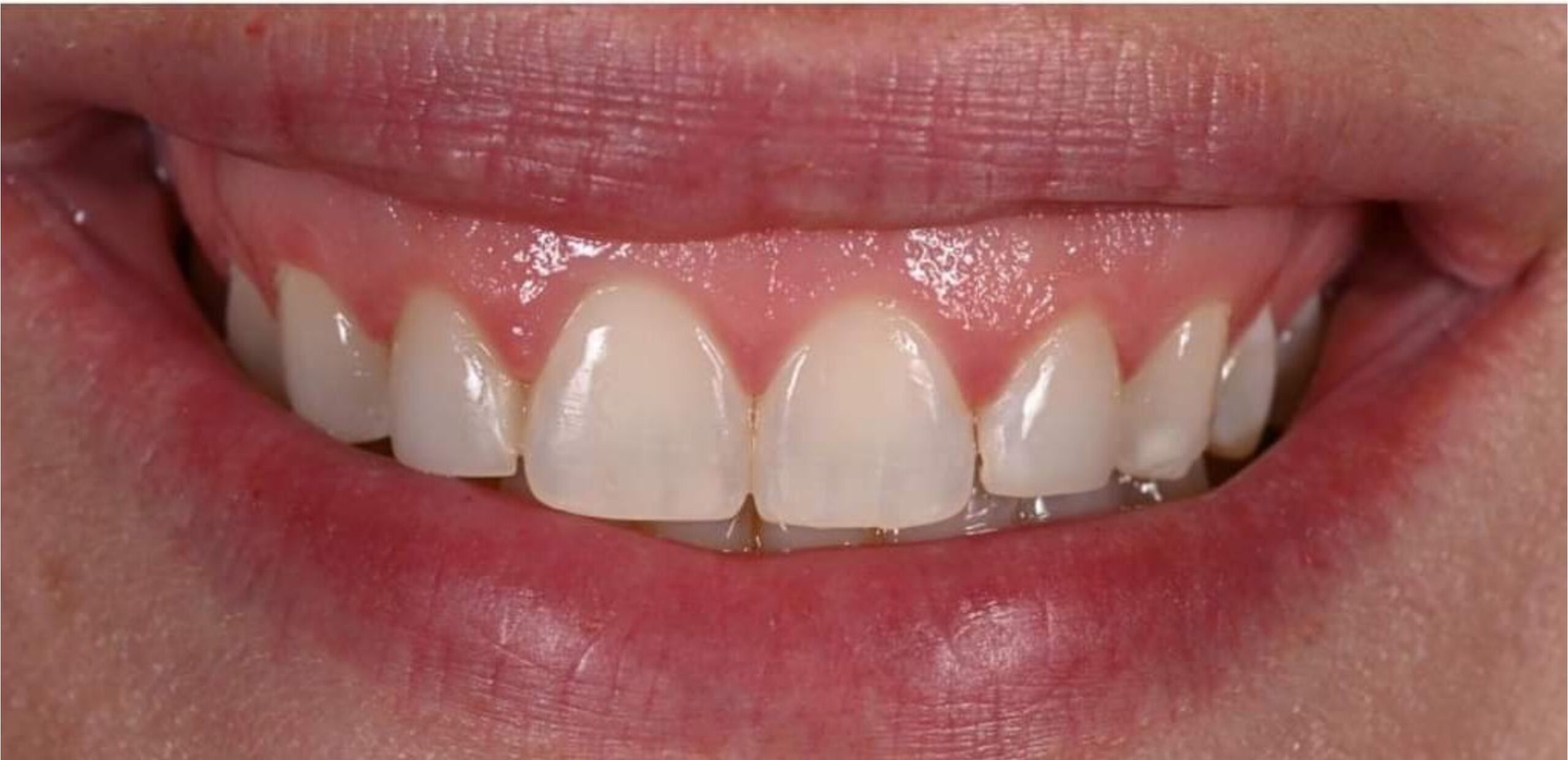 Before Hollywood Smile