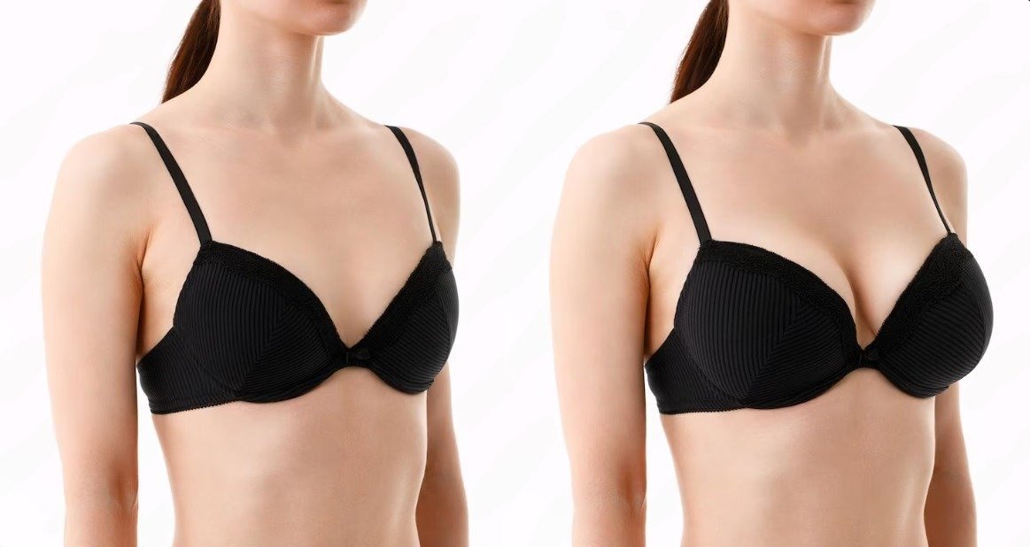 Before and After Breast Fillers Result