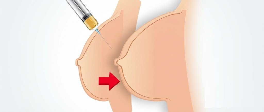 breast filler