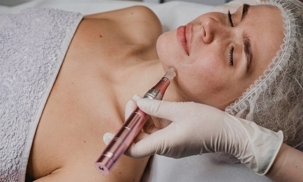 Dermapen microneedling treatment on facial skin