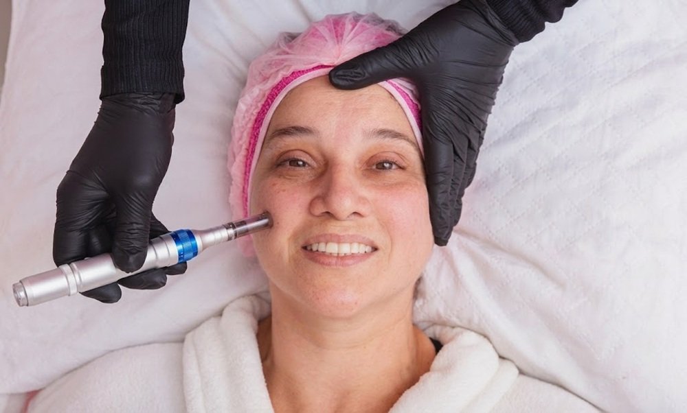 Good Candidate for Dermapen Microneedling