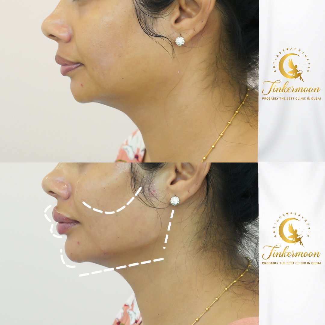 What Are Dermal Fillers?