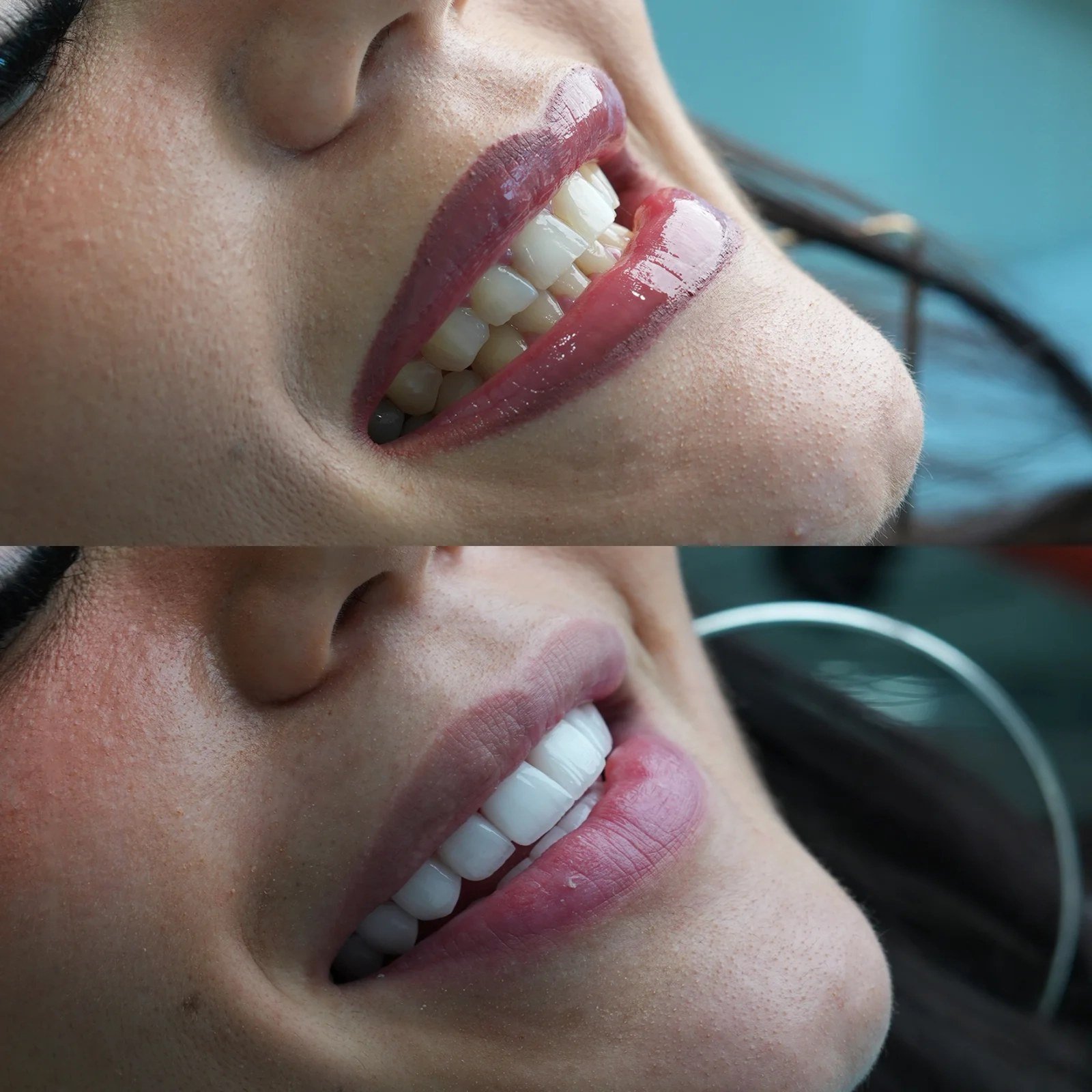 Before and after comparison of professional dental cleaning showing brighter and whiter teeth at Tinkermoon Clinic Dubai.