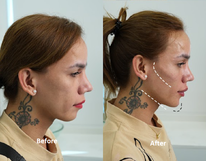 Dermal Fillers Cost in Dubai