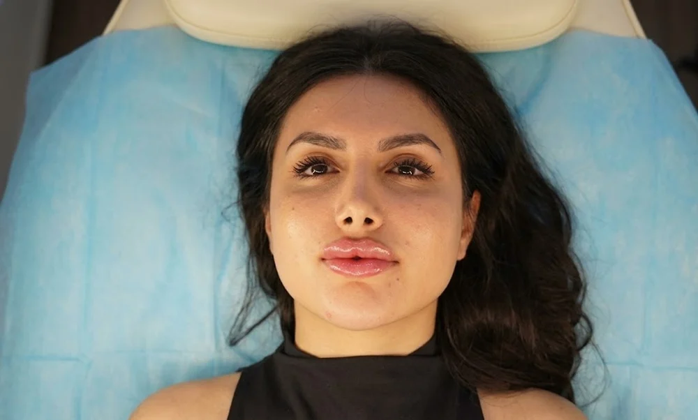 dermal fillers, an improvement may be visible soon after treatment