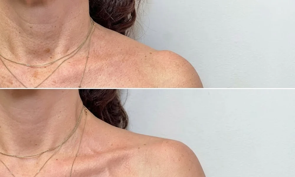 trapezius muscles feel tense or appear highly developed