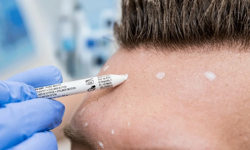 Baby Botox or Traditional Botox