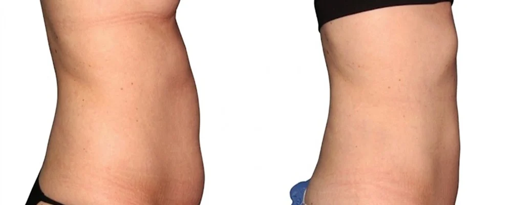 Non-surgical fat reduction refers to body contouring