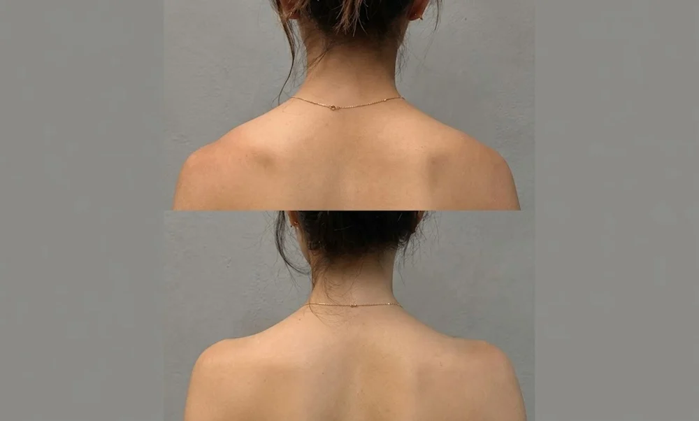 TrapTox may make the shoulders look narrower or less