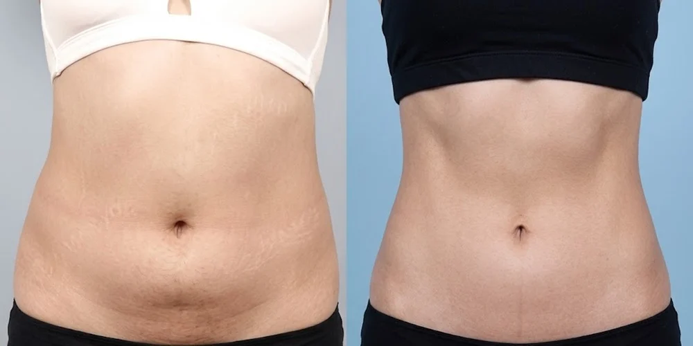 Liposuction vs. Non-Surgical Fat Reduction