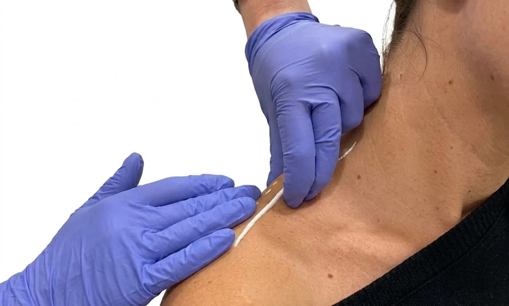 Botulinum toxin gradually reduces muscle activity