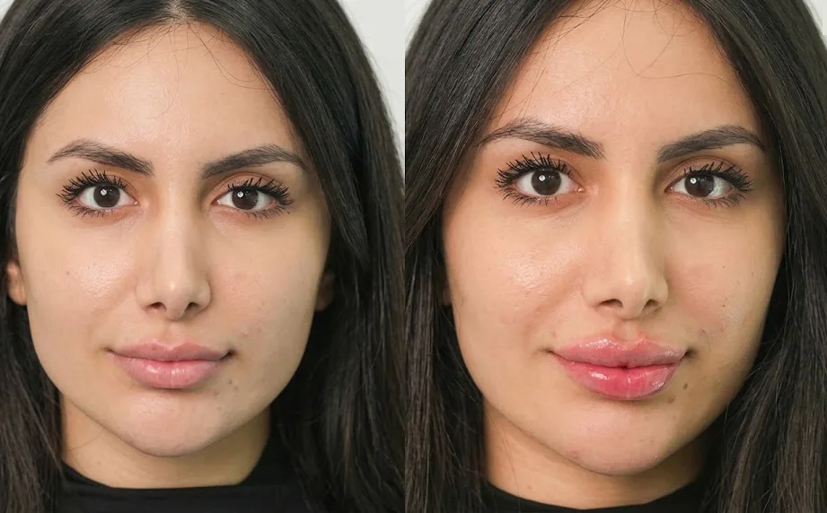 Before and after lip dermal filler results
