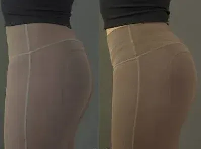 Different buttock shapes before and after contouring with body fillers