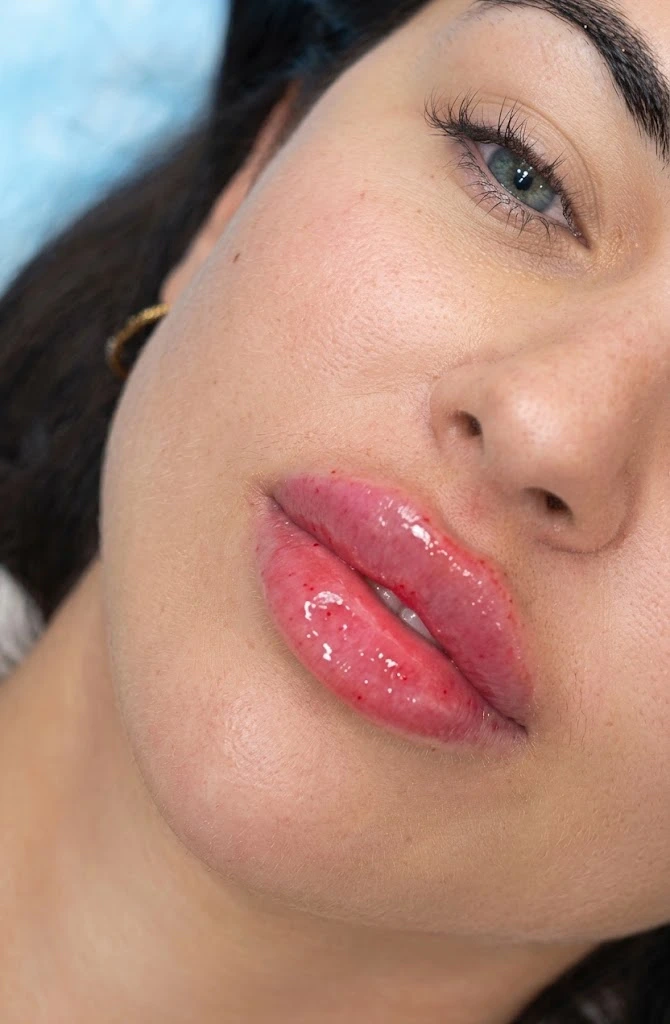 Lip fillers after treatment — plump lips result at Tinkermoon Clinic Dubai