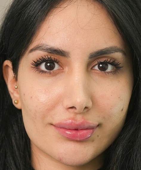 Lip fillers after treatment — fuller natural lips at Tinkermoon Clinic Dubai