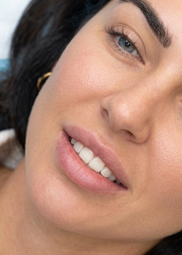 Lip fillers before treatment — angled close-up at Tinkermoon Clinic Dubai