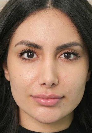 Lip fillers before treatment — front portrait at Tinkermoon Clinic Dubai