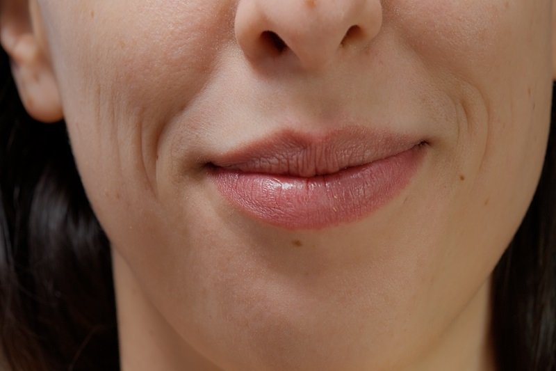 Uneven lip texture after filler