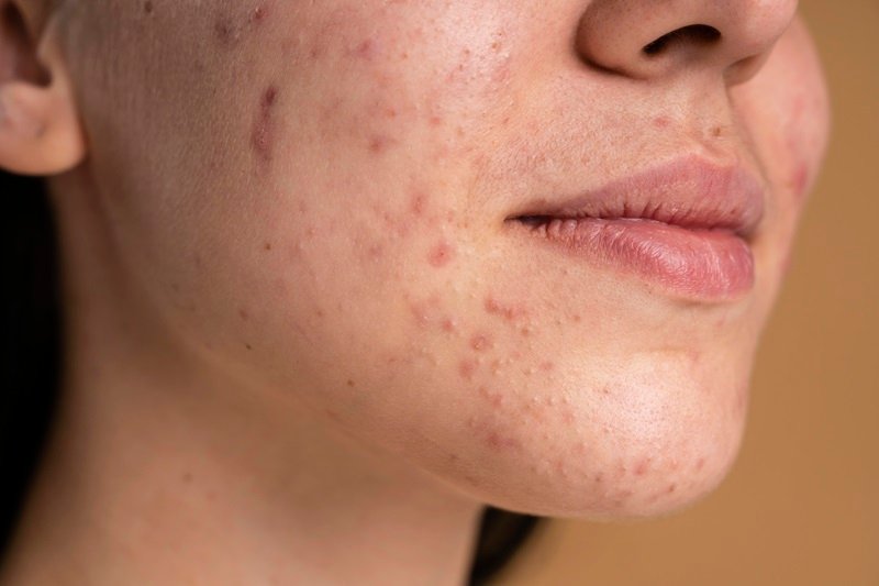 Acne and clogged pores on facial skin