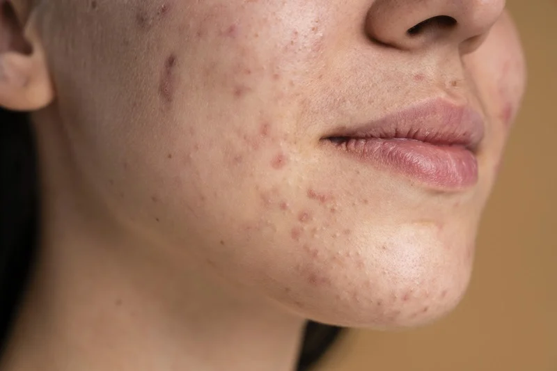 Sculptra treatment for nasolabial folds before and after