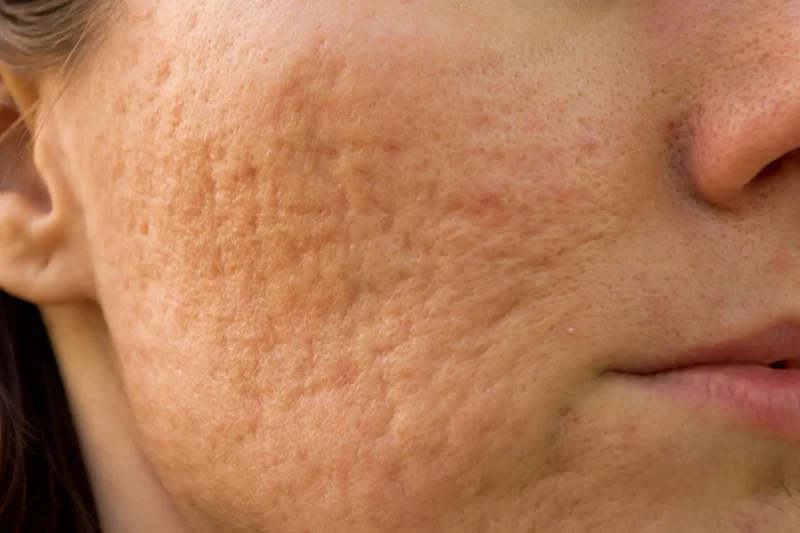 Fine lines and uneven skin texture on the face
