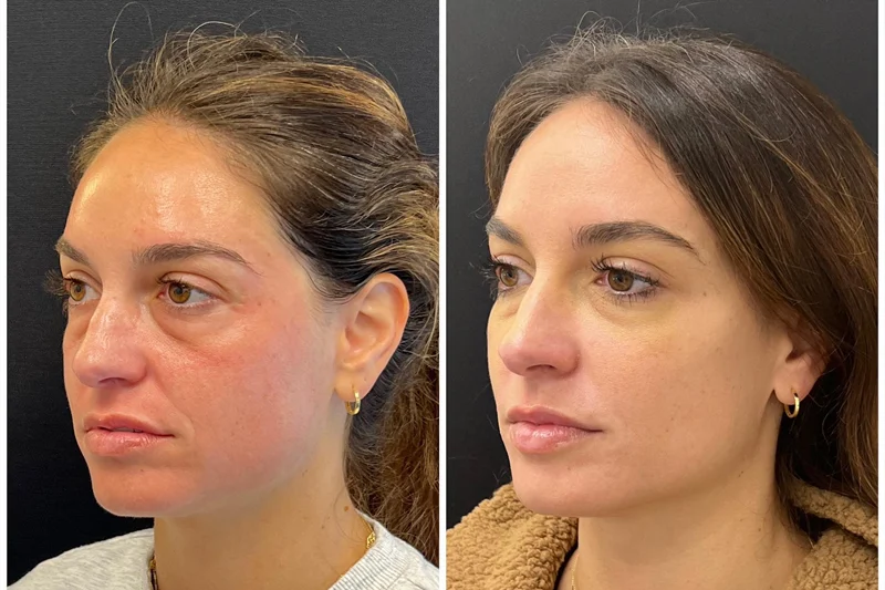 Sculptra and dermal fillers for facial rejuvenation comparison