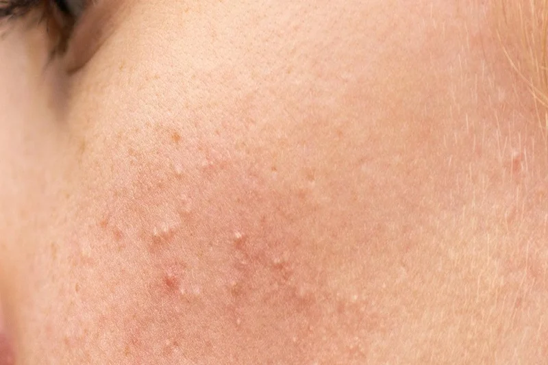 Dermal filler safety for hollow temples