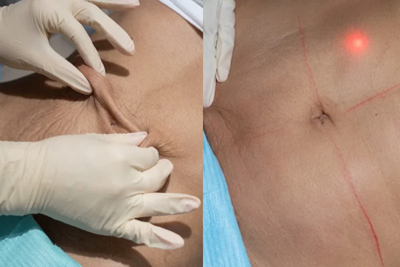 Liposuction for belly fat