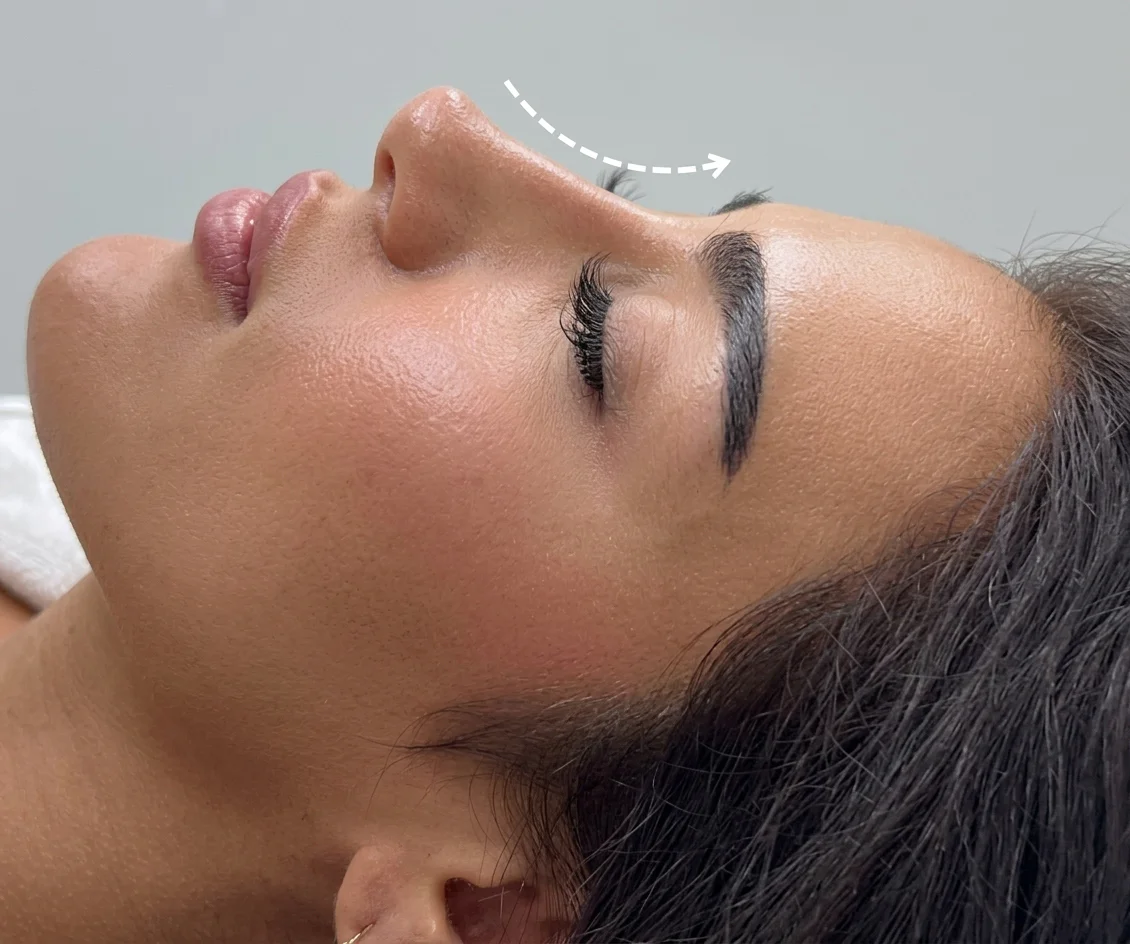Close-up profile with a dashed contour arrow illustrating rhinoplasty nose reshaping at Tinkermoon Clinic Dubai